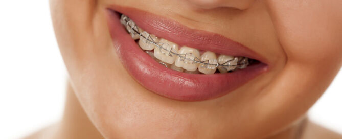 Picture of person with braces